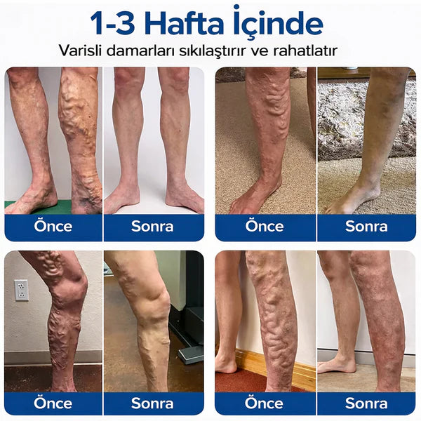 DermaVen Mikroiğneli Varis Bakım Bandı