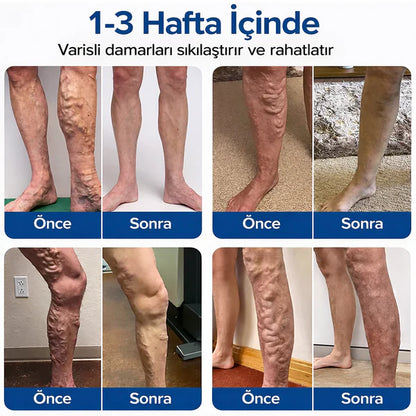 DermaVen Mikroiğneli Varis Bakım Bandı